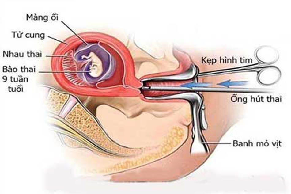 Ảnh minh họa hút điều hòa kinh nguyệt